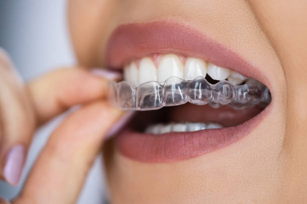Braces & Aligners service at Himalaya Dental House