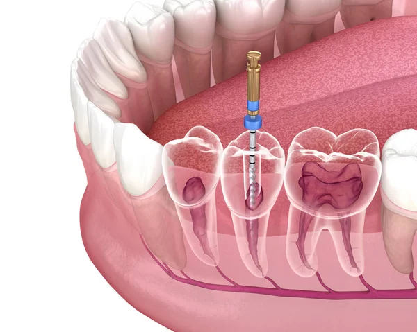 Root Canal Treatment service at Himalaya Dental House
